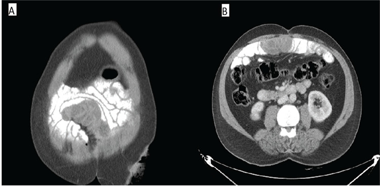 A Rare Hernia Mimicking Implant in a Patient with Rectal Adenocarcinoma: Internal Herniation.