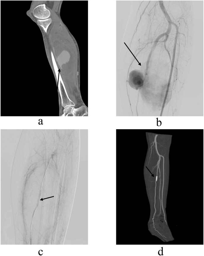 Management of traumatic peripheral artery pseudoaneurysm: A 10-year experience at a single center