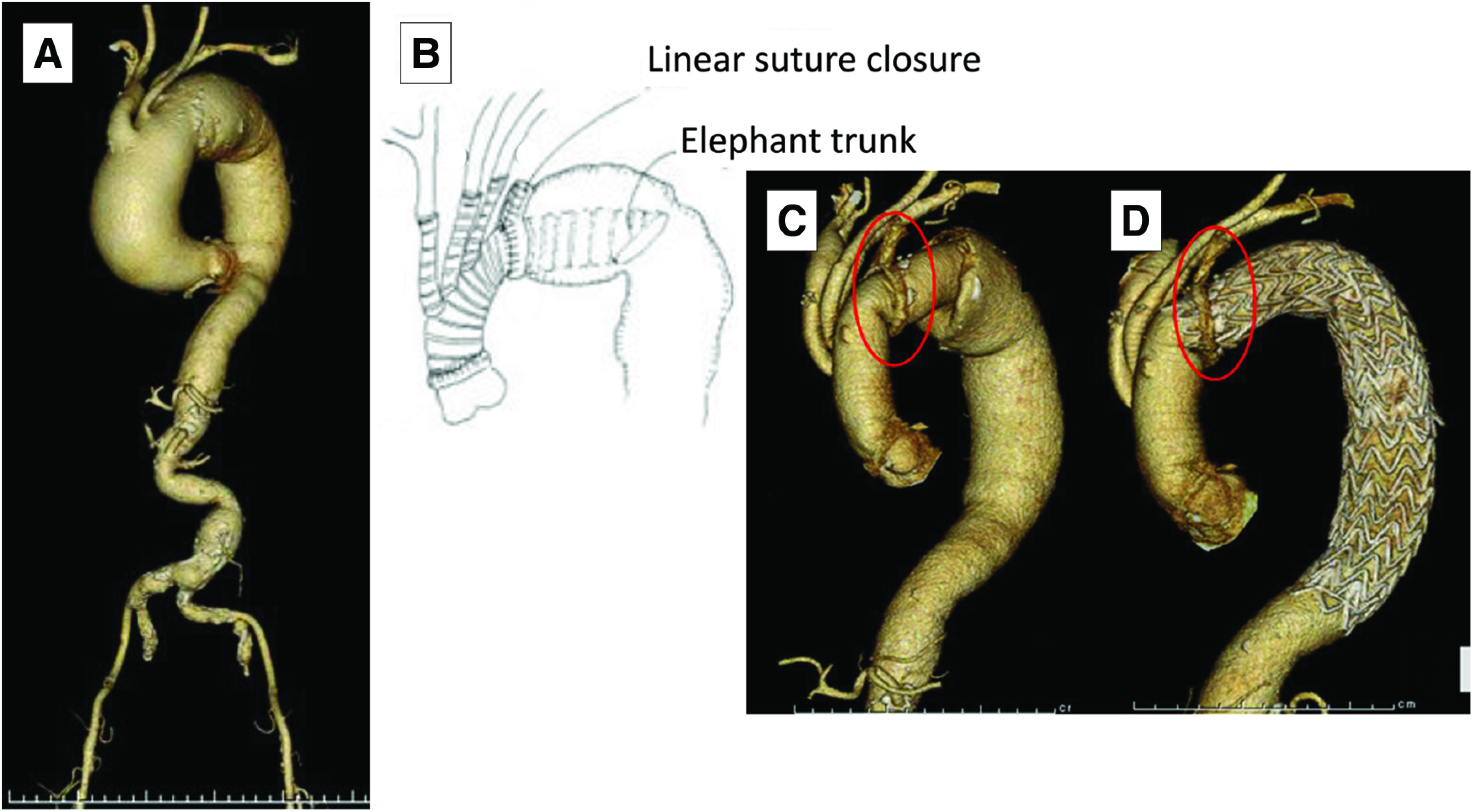 Surgical Approaches to Single-Stage Extended Aortic Repair from the Ascending to the Distal Descending Aorta.