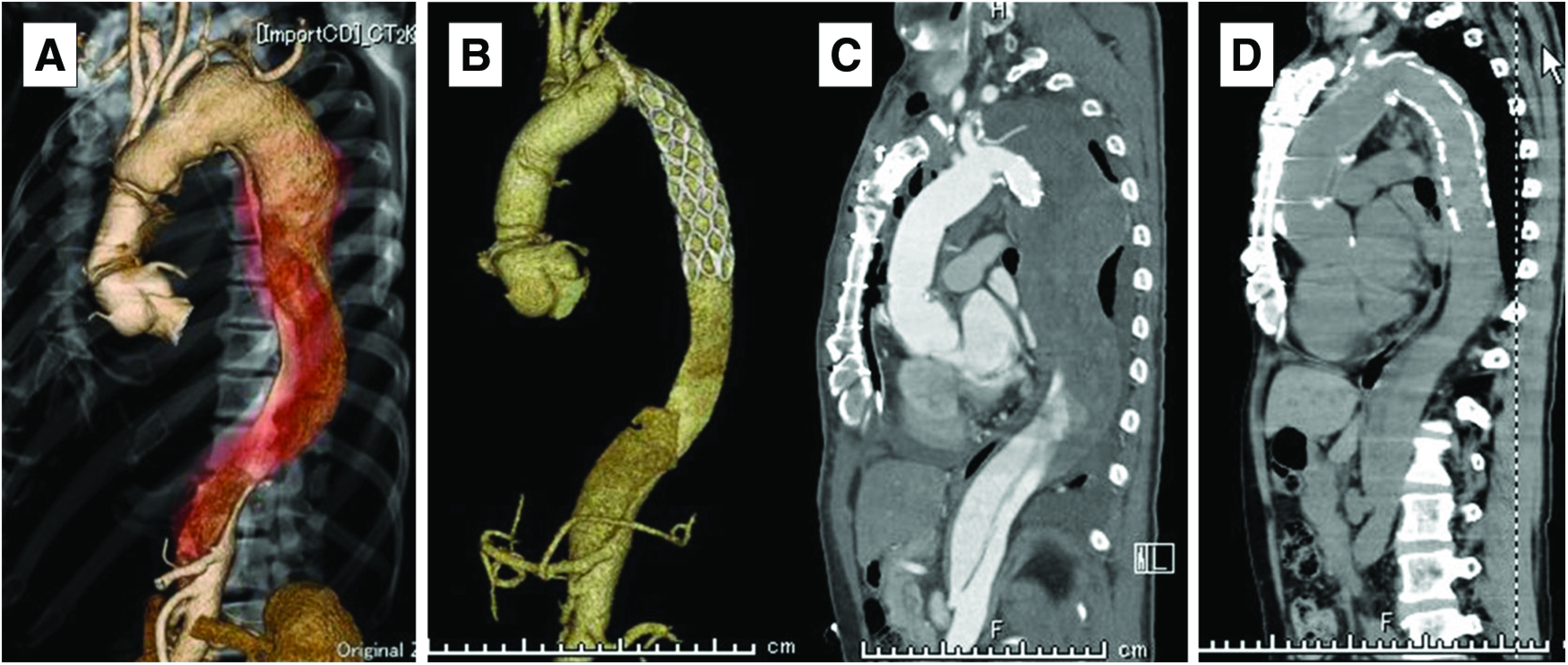 Surgical Approaches to Single-Stage Extended Aortic Repair from the Ascending to the Distal Descending Aorta.