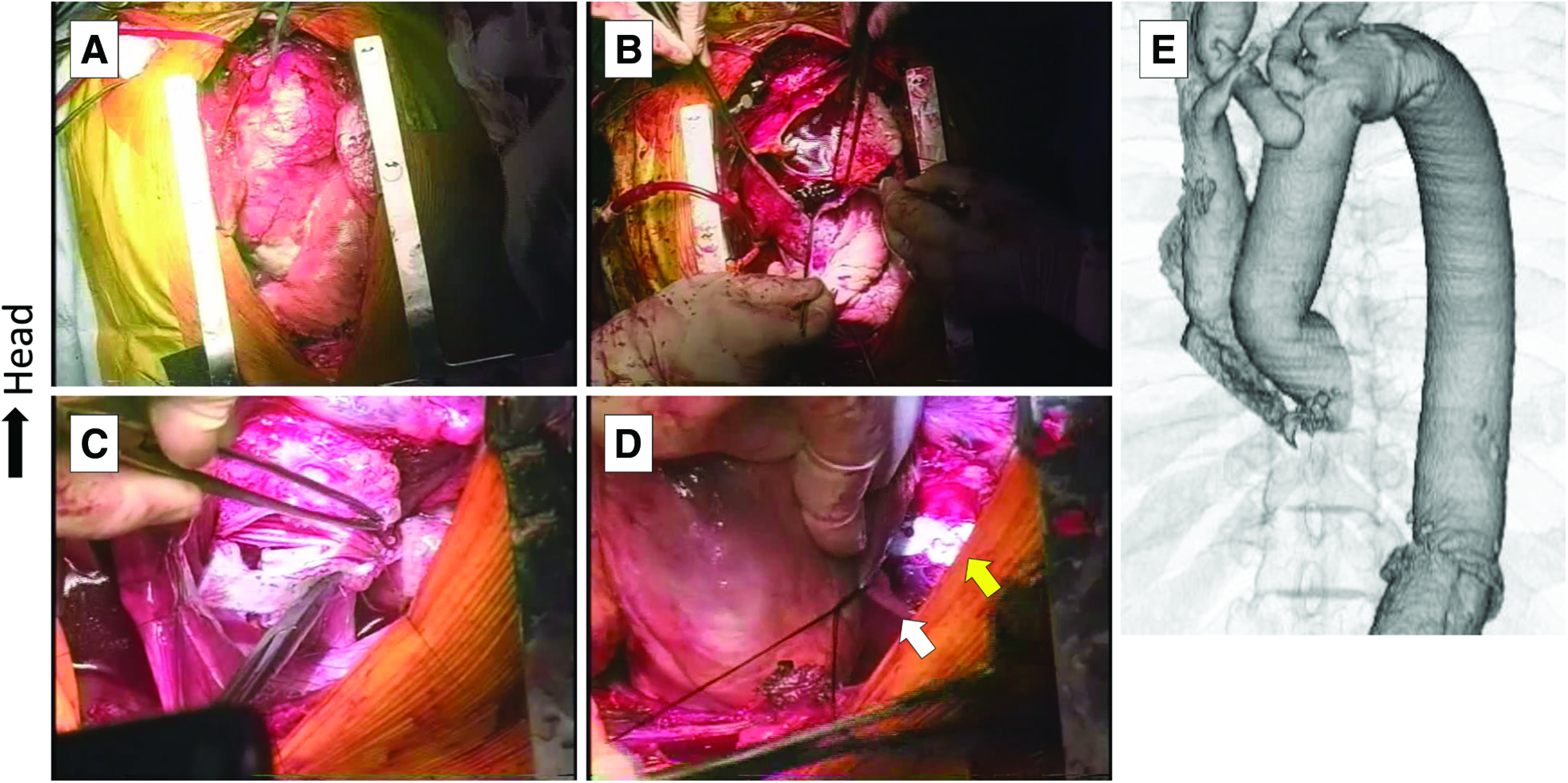 Surgical Approaches to Single-Stage Extended Aortic Repair from the Ascending to the Distal Descending Aorta.