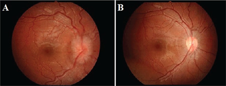 Efficacy of Optic Nerve Sheath Fenestration in Patients with Increased Intracranial Pressure.