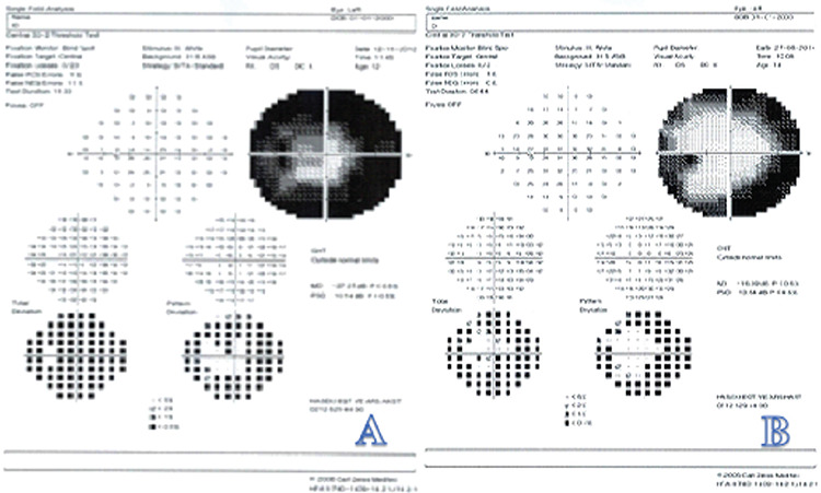 Efficacy of Optic Nerve Sheath Fenestration in Patients with Increased Intracranial Pressure.