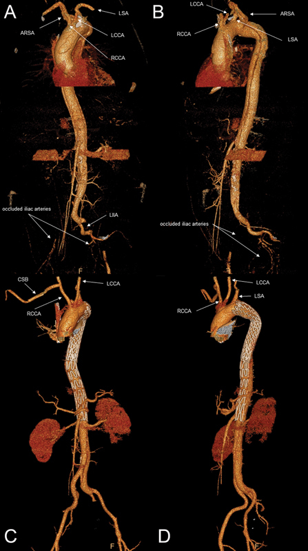 How to Treat Type B Aortic Dissections in the Presence of an Aberrant Right Subclavian Artery: A Systematic Review.