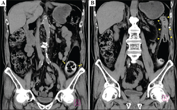 A case of colonic fecal impaction caused by excessive dietary fiber intake that was endoscopically treated with intra-fecal injection of a bowel-cleansing agent.