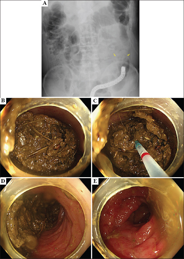 A case of colonic fecal impaction caused by excessive dietary fiber intake that was endoscopically treated with intra-fecal injection of a bowel-cleansing agent.