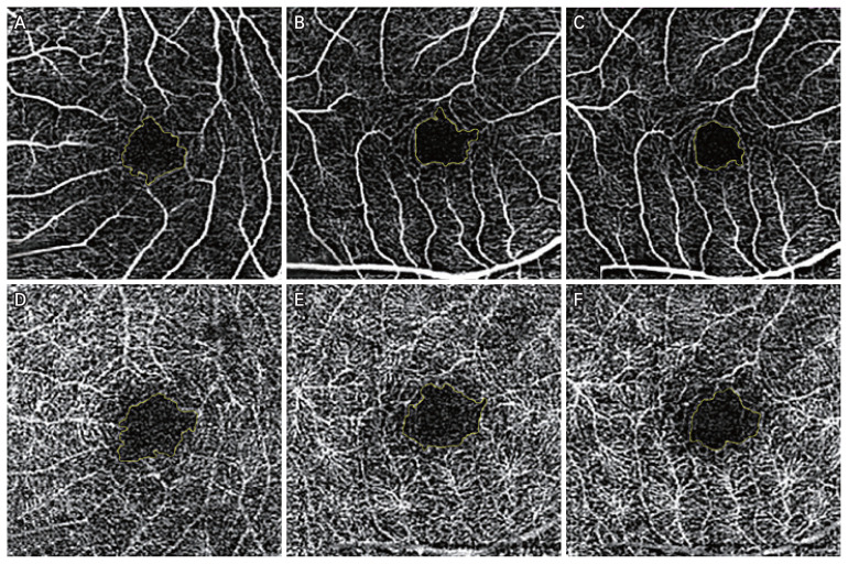 Analyses of Foveal Avascular Zone in Patients with General Blunt Ocular Trauma Using Optical Coherence Tomography Angiography.