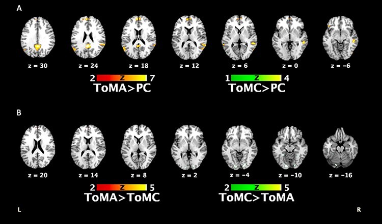 Activation of the left medial temporal gyrus and adjacent brain areas during affective theory of mind processing correlates with trait schizotypy in a nonclinical population.