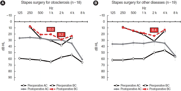 Improved Bone Conduction Hearing After Middle Ear Surgery: Investigation of the Improvement Mechanism.