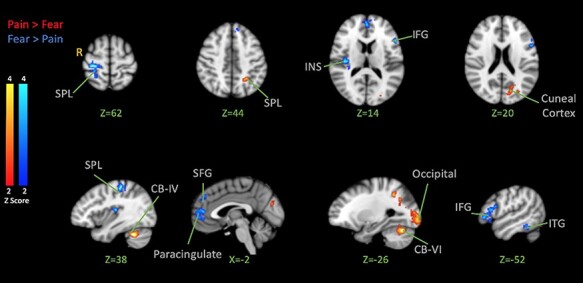 Brain responses to the vicarious facilitation of pain by facial expressions of pain and fear.