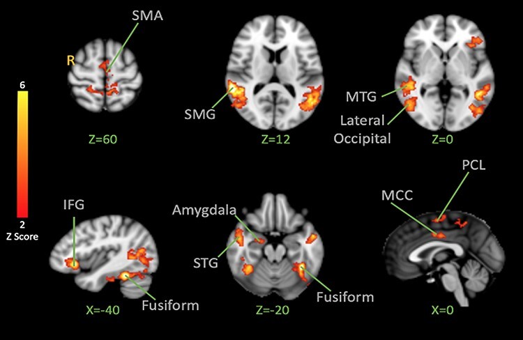 Brain responses to the vicarious facilitation of pain by facial expressions of pain and fear.