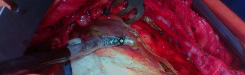 Case Report of Cryo Nerve Block in a Patient Undergoing Full Sternotomy: A Novel Approach to Pain Control in Cardiac Surgery.