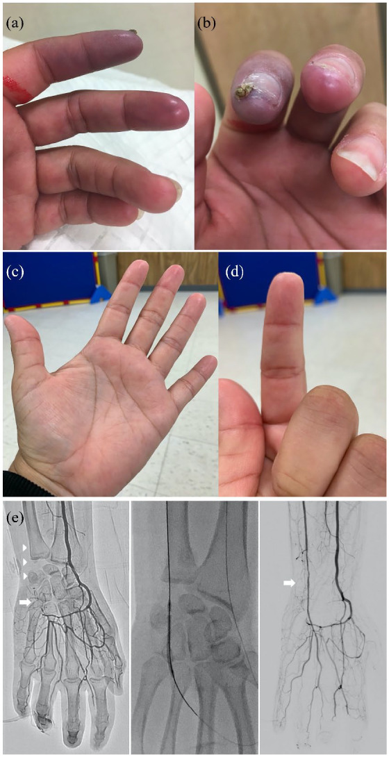 Percutaneous revascularization for the treatment of refractory digital ischemia in systemic sclerosis.