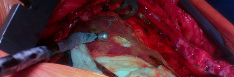 Case Report of Cryo Nerve Block in a Patient Undergoing Full Sternotomy: A Novel Approach to Pain Control in Cardiac Surgery.