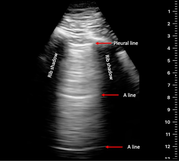 Feasibility of tele-guided patient-administered lung ultrasound in heart failure.