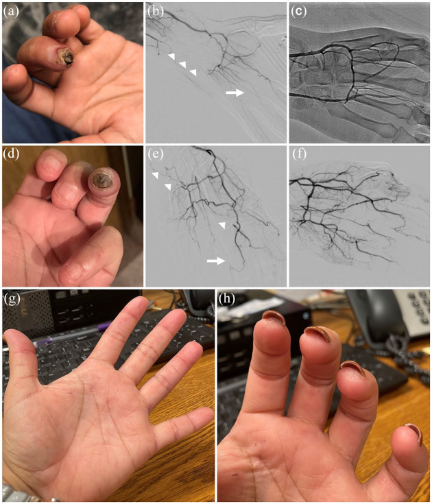 Percutaneous revascularization for the treatment of refractory digital ischemia in systemic sclerosis.