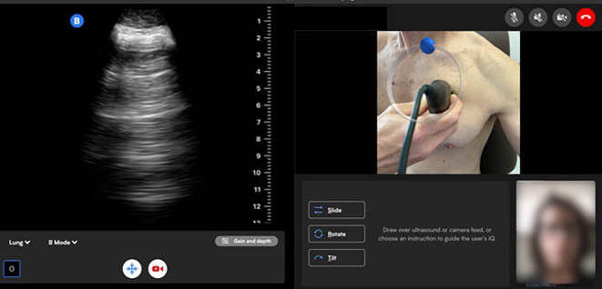 Feasibility of tele-guided patient-administered lung ultrasound in heart failure.