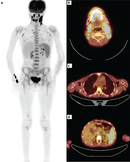 <sup>18</sup>F-FDG PET/CT Findings Overlapping Lymphoma in a Patient with Systemic Juvenile Idiopathic Arthritis.