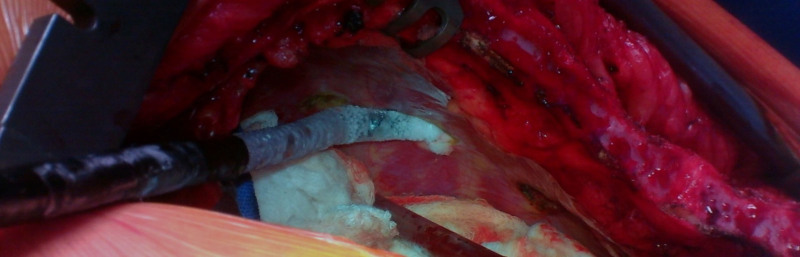 Case Report of Cryo Nerve Block in a Patient Undergoing Full Sternotomy: A Novel Approach to Pain Control in Cardiac Surgery.