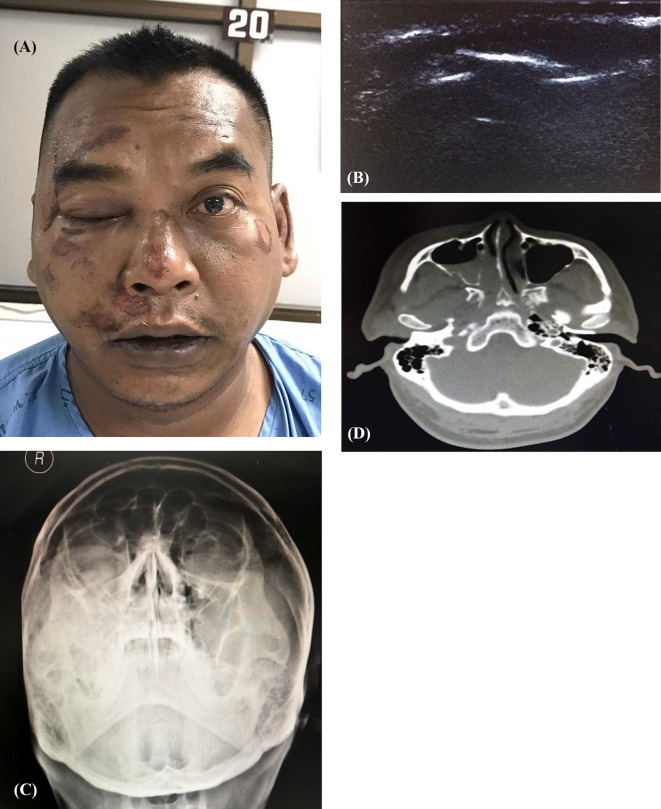 Accuracy of linear-probe ultrasonography in diagnosis of infraorbital rim fractures.