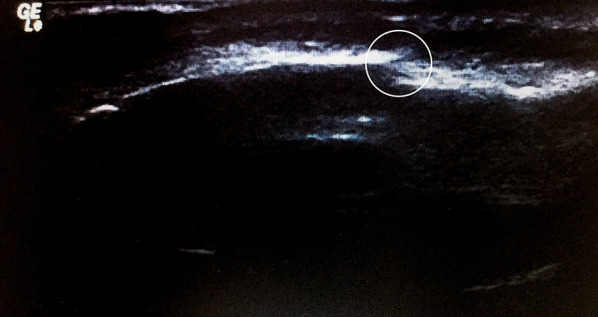 Accuracy of linear-probe ultrasonography in diagnosis of infraorbital rim fractures.