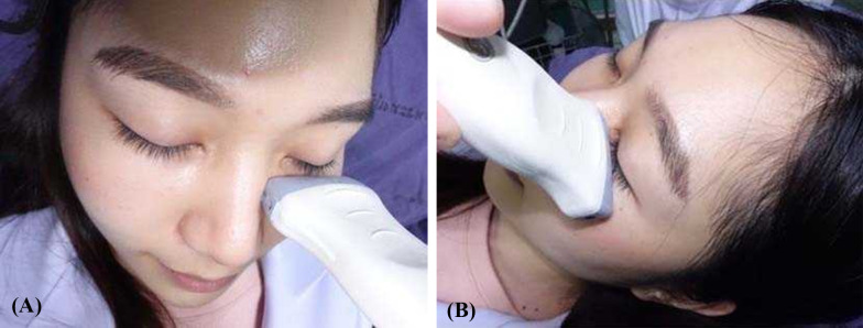 Accuracy of linear-probe ultrasonography in diagnosis of infraorbital rim fractures.