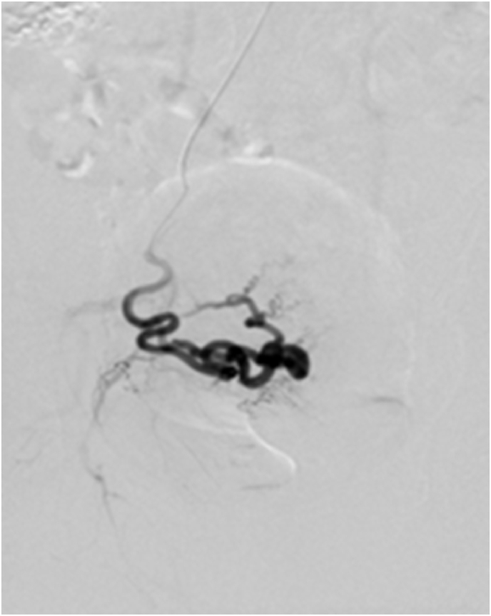 Efficacy of patient-controlled hydromorphone analgesia in those undergoing uterine fibroid artery embolization via the right radial artery