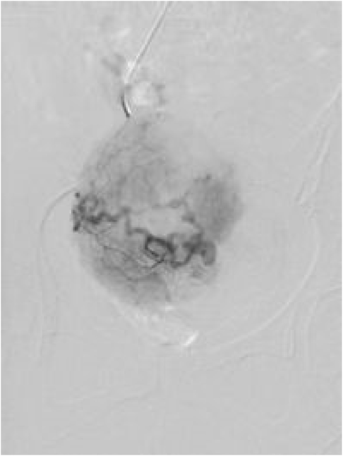 Efficacy of patient-controlled hydromorphone analgesia in those undergoing uterine fibroid artery embolization via the right radial artery