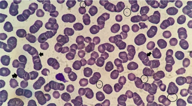 Fatal septic shock and Waterhouse-Friderichsen syndrome caused by serovar B Capnocytophaga canimorsus in an immunocompetent patient. Case report and review.