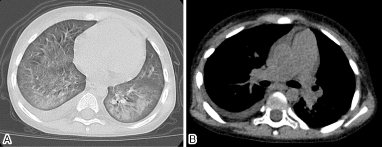Pulmonary veno-occlusive disease after respiratory syncytial virus infection in a post hematopoietic stem cell transplantation patient.