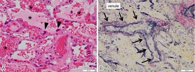 Pulmonary veno-occlusive disease after respiratory syncytial virus infection in a post hematopoietic stem cell transplantation patient.
