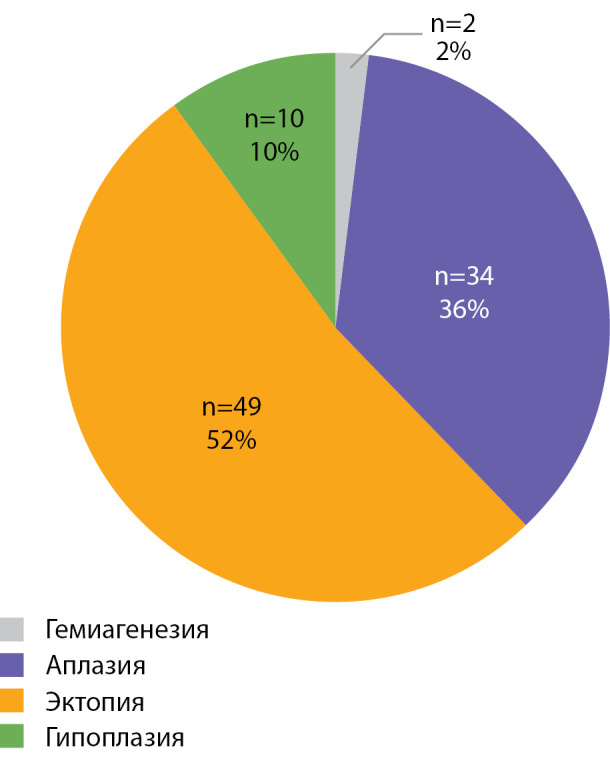 [Pathogenic <i>TSHR</i> variants in children with thyroid dysgenesis].