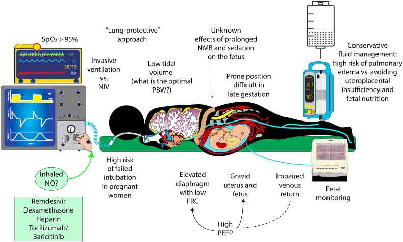 Pregnancy and Severe ARDS with COVID-19: Epidemiology, Diagnosis, Outcomes and Treatment