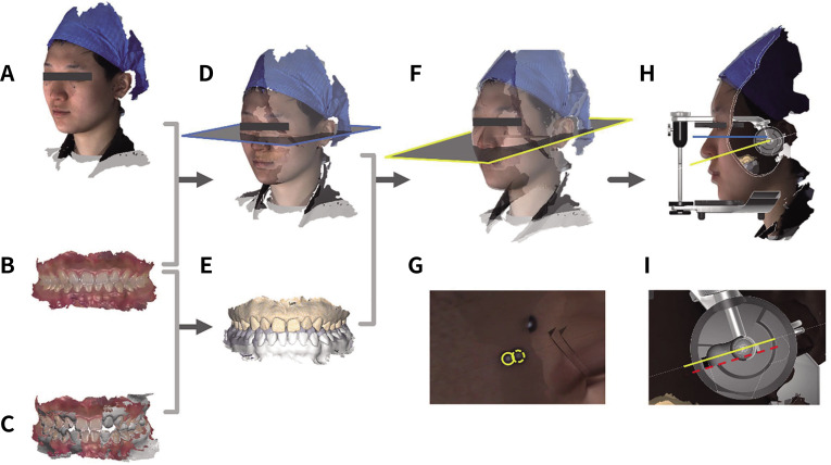 A comparative study to measure the sagittal condylar inclination using mechanical articulator, virtual articulator and jaw tracking device.