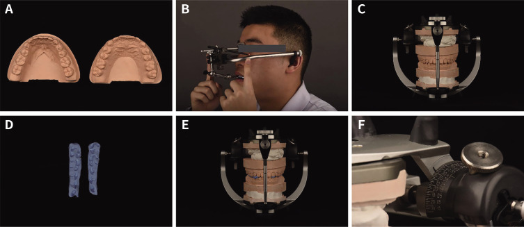 A comparative study to measure the sagittal condylar inclination using mechanical articulator, virtual articulator and jaw tracking device.