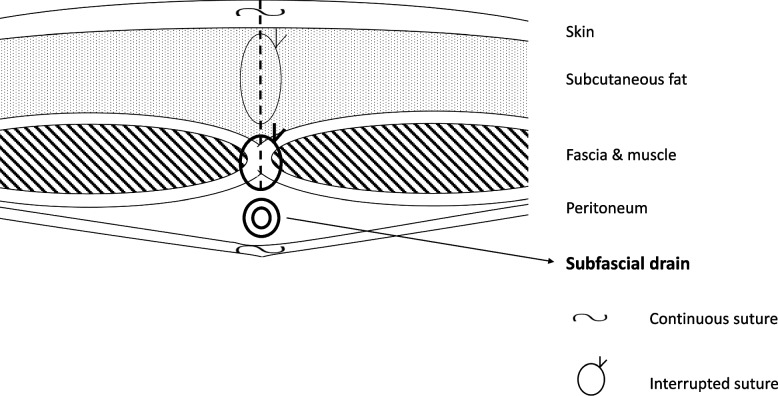 Prevention of incisional surgical site infection by subfascial closed suction drainage after open laparotomy: a single surgeon experience in 250 consecutive patients.