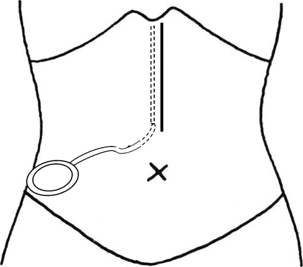 Prevention of incisional surgical site infection by subfascial closed suction drainage after open laparotomy: a single surgeon experience in 250 consecutive patients.