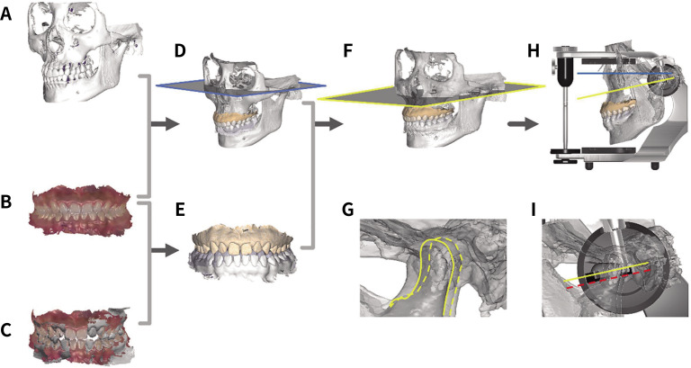 A comparative study to measure the sagittal condylar inclination using mechanical articulator, virtual articulator and jaw tracking device.