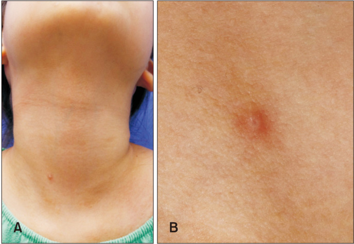 Mucinous Syringometaplasia on the Neck in a Child.