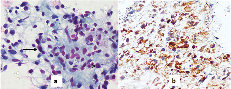 Significance of Clinico-radiological Correlation in a Patient with Pulmonary Intimal Sarcoma Simulating as Pulmonary Thromboembolism.