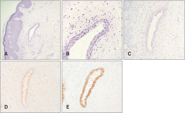 Mucinous Syringometaplasia on the Neck in a Child.