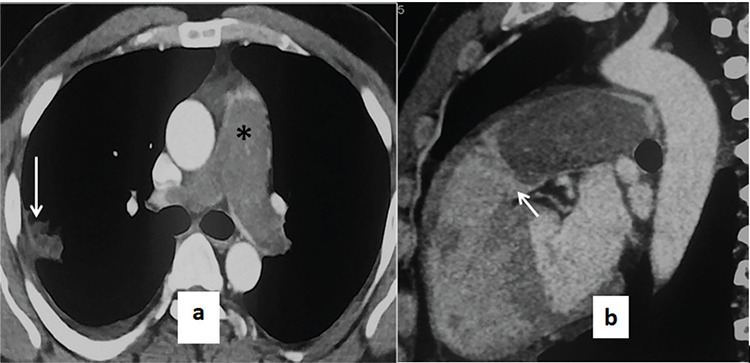 Significance of Clinico-radiological Correlation in a Patient with Pulmonary Intimal Sarcoma Simulating as Pulmonary Thromboembolism.