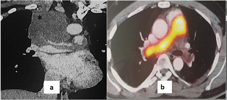 Significance of Clinico-radiological Correlation in a Patient with Pulmonary Intimal Sarcoma Simulating as Pulmonary Thromboembolism.