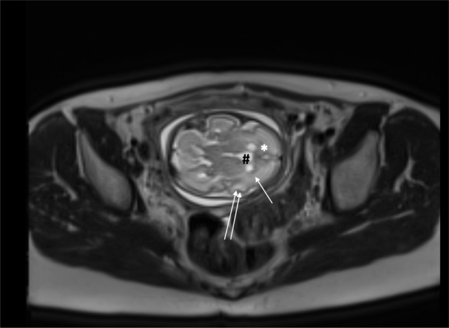 MRI features of perifibrinous deposits in the placenta due to COVID-19.