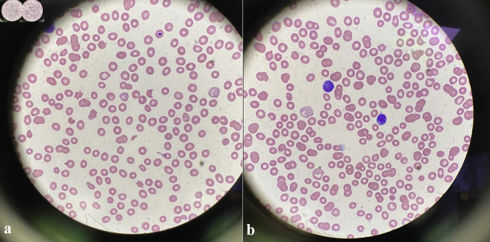 Mature Type T-Lymphoblastic Leukemia/Lymphoma Presenting With Isolated Central Nervous System Symptomatology in a Patient With Giant Cell Arteritis on Long-Term Steroid Treatment.