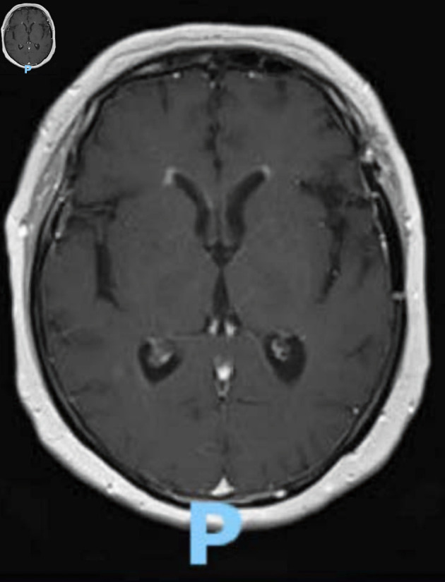 Mature Type T-Lymphoblastic Leukemia/Lymphoma Presenting With Isolated Central Nervous System Symptomatology in a Patient With Giant Cell Arteritis on Long-Term Steroid Treatment.