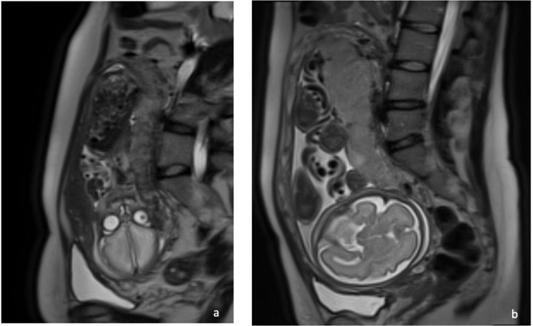 MRI features of perifibrinous deposits in the placenta due to COVID-19.