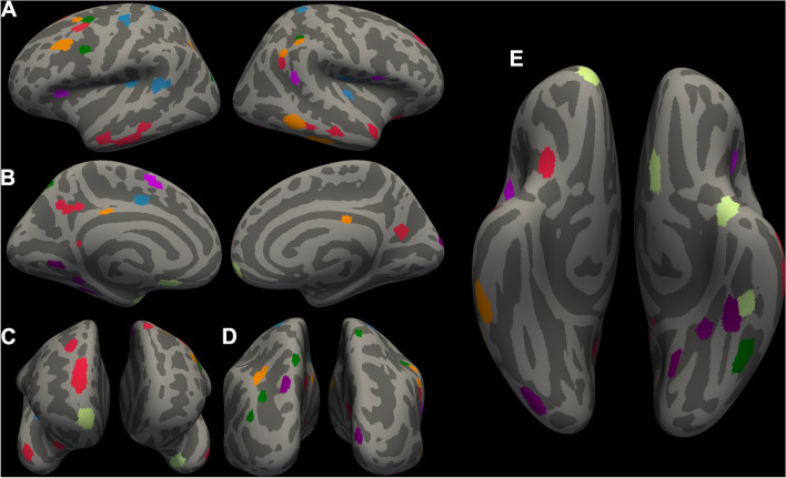 Machine learning based identification of structural brain alterations underlying suicide risk in adolescents.