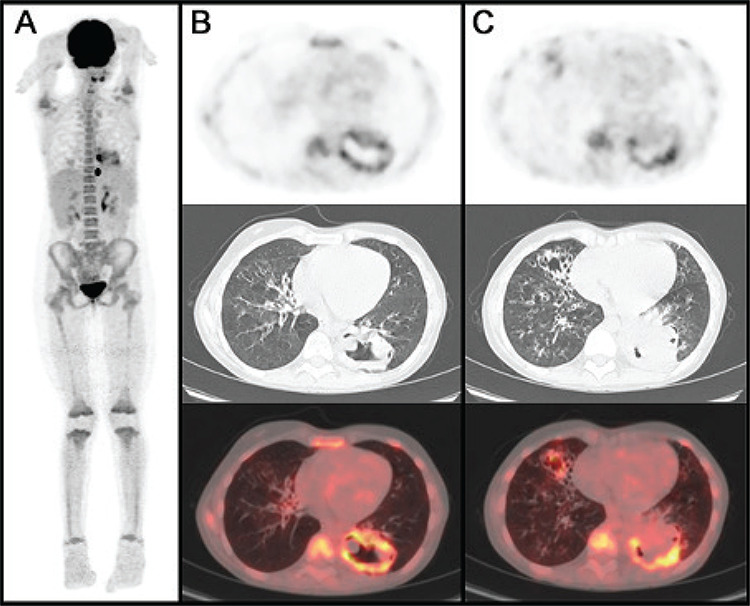 <sup>18</sup>F-FDG PET/CT Imaging of a Grade 3 Lymphomatoid Granulomatosis in an Immunocompromised Pediatric Patient.