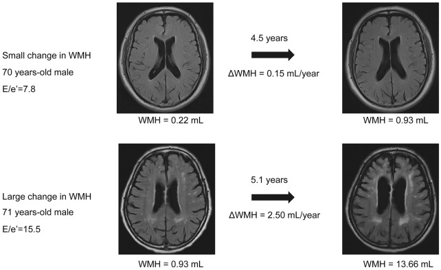 Septal E/e' Ratio Is Associated With Cerebral White Matter Hyperintensity Progression in Young-Old Hypertensive Patients.